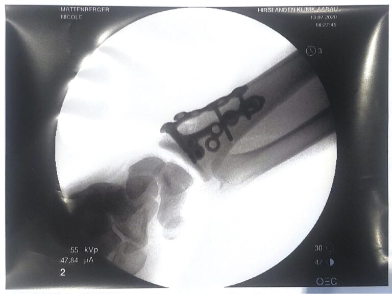 X-ray fracture
